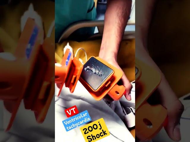 200j SHOCK to VT patient