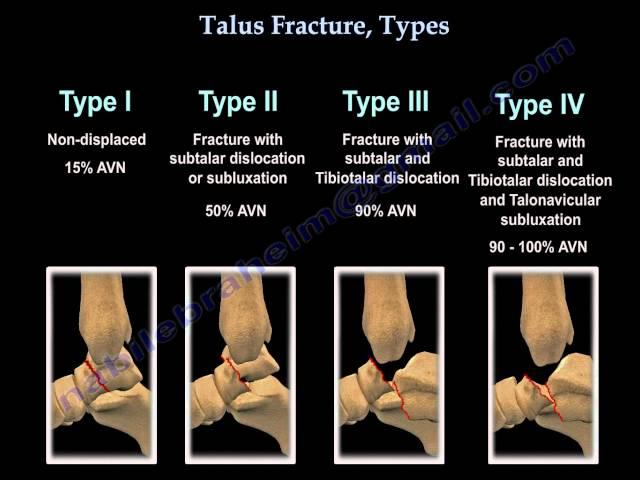 Talus Fracture Types - Everything You Need To Know - Dr. Nabil Ebraheim