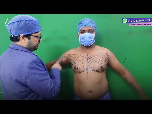 Grade - 2B Gynecomastia surgery || Male breast Reduction || Dr. Jayanta Bain plastic surgeon