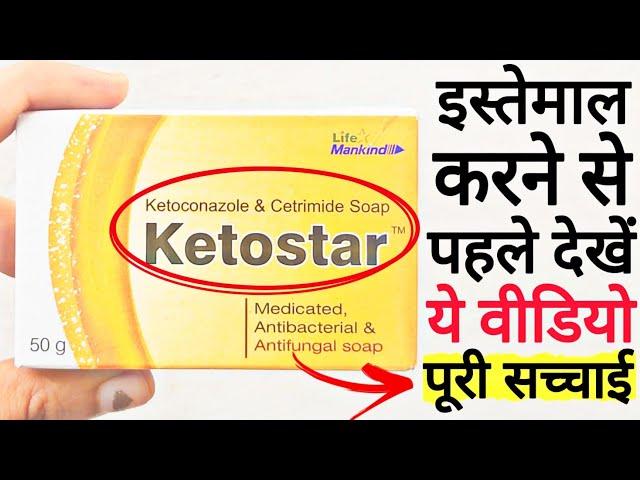 Ketoconazole Soap | Ketostar Soap | Ketoconazole Cetrimide Soap | Ketostar Soap Uses In Hindi