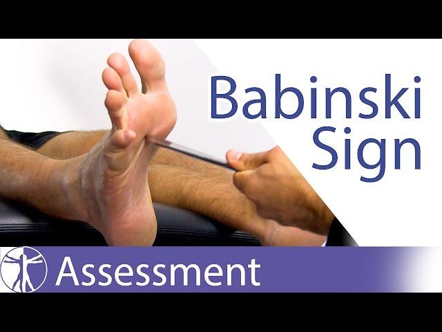 The Babinski Sign or Reflex | Upper Motor Neuron Lesion