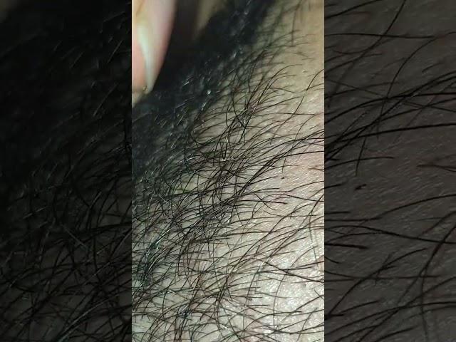 #ingrownhair #satisfying #hair #remove #asmr #hairstyle #trending #oddlysatisfying #waxing