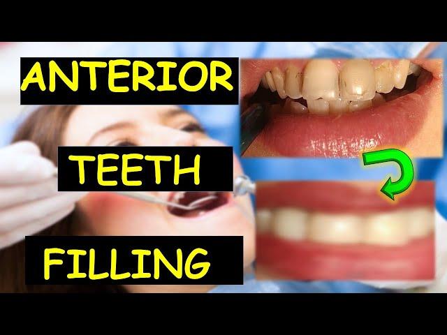 Tooth Filling| Composite Dental Filling | Filling with composite | Front teeth filling