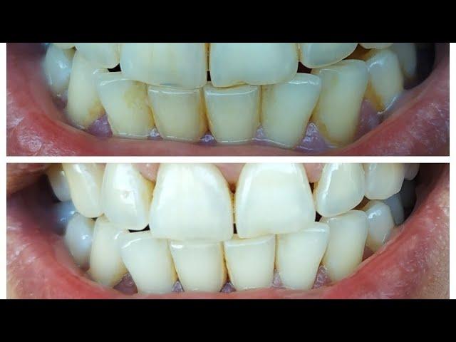 Home whitening and dental calculus cleaning,plaque removal. Brushing your teeth without baking soda!