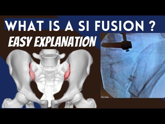 SI Joint Fusion  Explanation of how it can stop back pain permanently