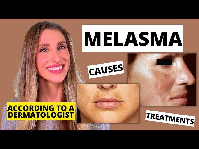 Best Melasma Treatment? Dermatologist Explains Melasma: Causes, At Home Treatments, & More