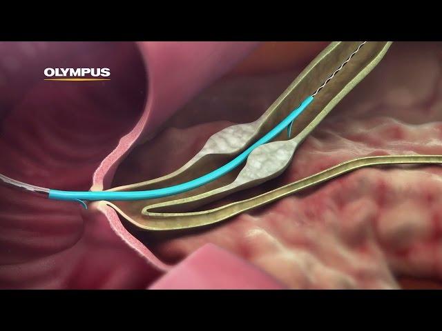 QuickPlaceV Biliary Stent