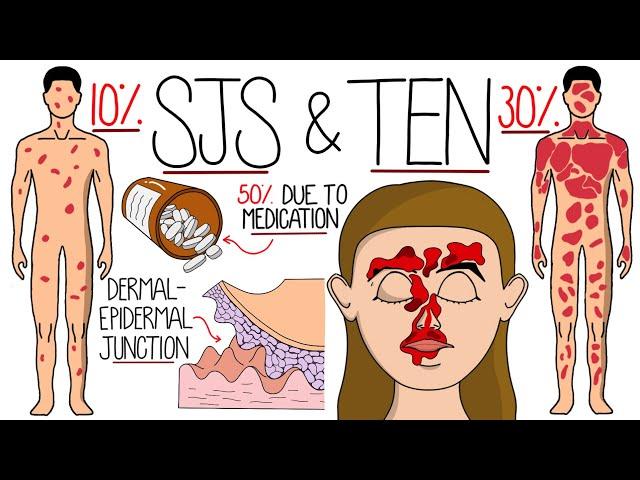 Understanding Stevens-Johnson Syndrome and Toxic Epidermal Necrolysis (SJS & TEN)