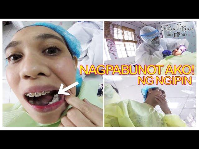 FOURTH MOLAR TOOTH REMOVAL | Reasons for Tooth Extraction | Daily Vlog | VP VideoEdits