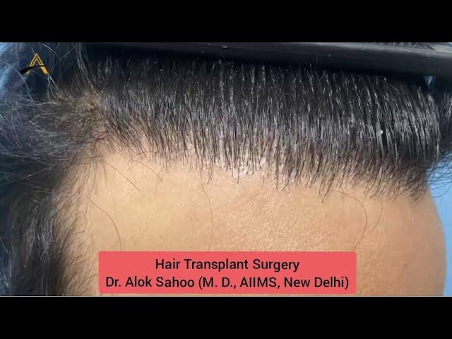 Hair Transplant Surgery | Dr.Alok Sahoo #hairtransformation #hairtransplantsuccesstories #hairstyle