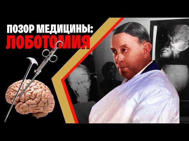 Самая постыдная Нобелевская премия: история лоботомии