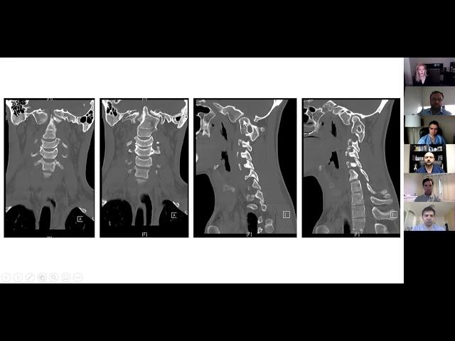 Virtual Global Spine Conference, April 13, 2020: Dr. Dahdaleh and Dr. Guiroy