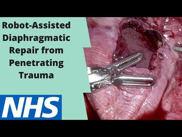 Robotic Diaphragm Repair after Penetrating Trauma