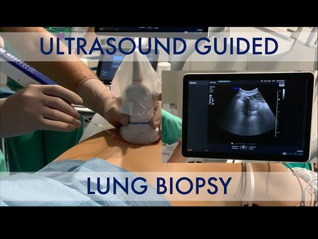 US-guided lung biopsy