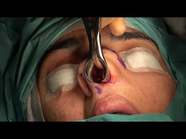 Septal Graft Obtaining-2: Bizrah Rhinoplasty