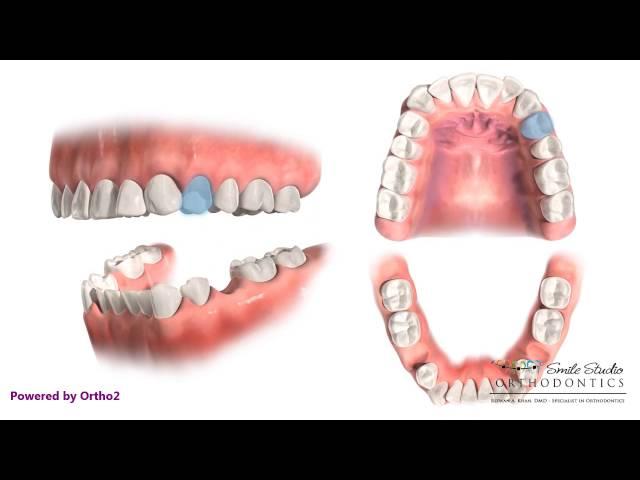 Upper 4 Lower 5 Extraction - Orthodontic Treatment