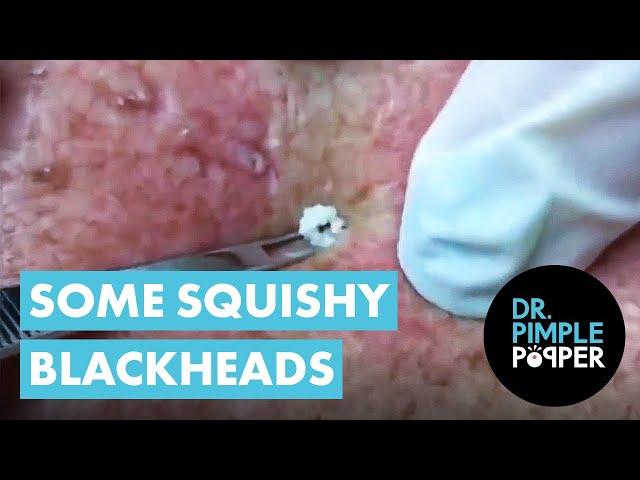 Some Squishy Blackheads