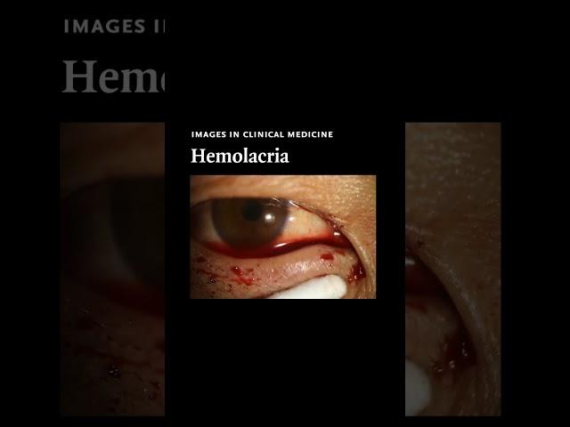 Hemolacria | NEJM