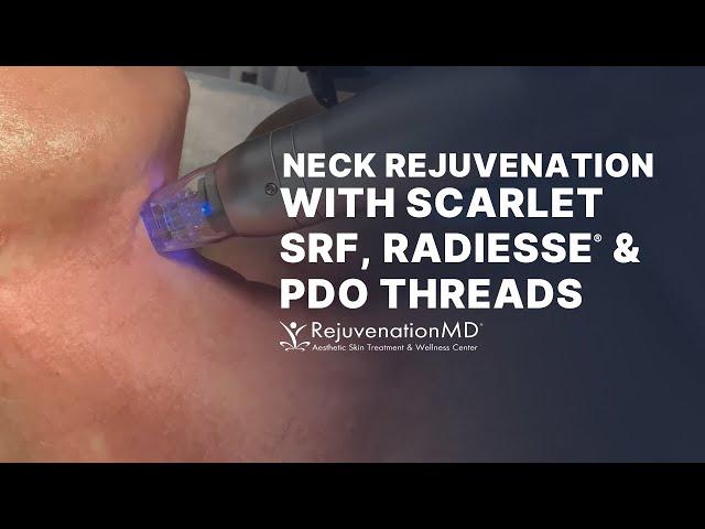 Scarlet SRF, PDO Threads, and RADIESSE | Explore Non-Surgical Neck Lift Options