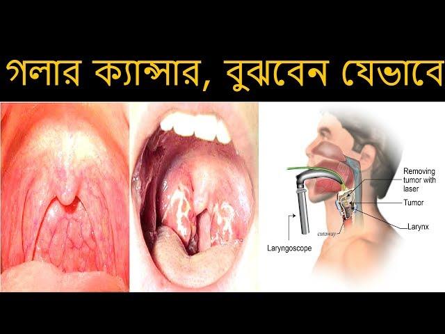 গলার ক্যান্সার, বুঝবেন যেভাবে ||Throat cancer, understand how to ||  Health Tips Ltd