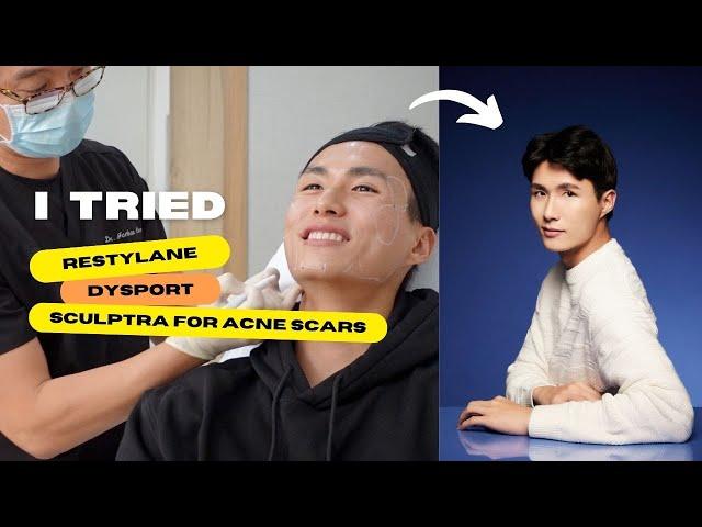 2023 ACNE SCAR UPDATE | non-invasive “plastic surgery”? Before & After 