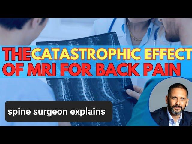 The catastrophic effect of MRI for back pain