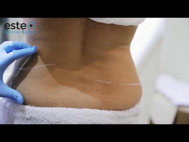 Cooltech | Fat Freezing | Este Medical Group