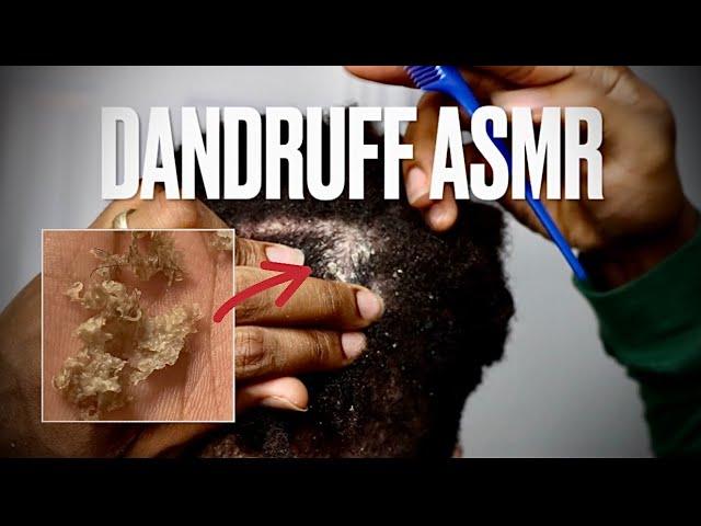 Dandruff Scratching ASMR | Removing Big Flakes From My Locs #dandruffremovalasmr #dreadlocksdandruff