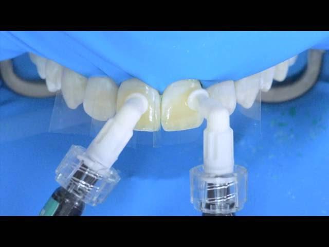 Fluorosis treatment using Icon infiltration, step by step