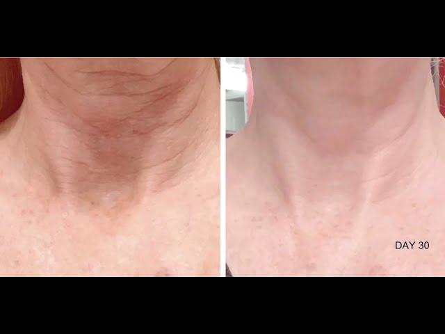 Denise Shares Her Nuovaluce Experience | Best Anti Aging Device 2019 | Nuovaluce Beauty