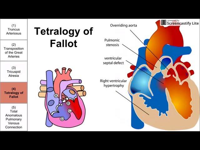 Cyanotic Congenital Heart Diseases