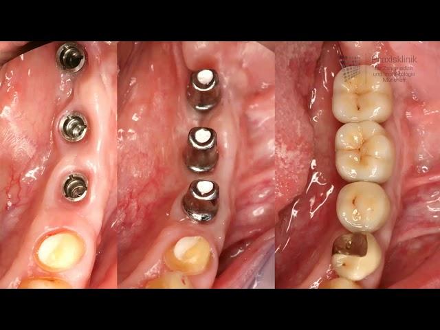 How do modern implant prosthetics work?