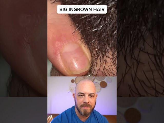 Derm reacts to enflamed ingrown hair removal on head! #dermreacts #doctorreacts #ingrownhair