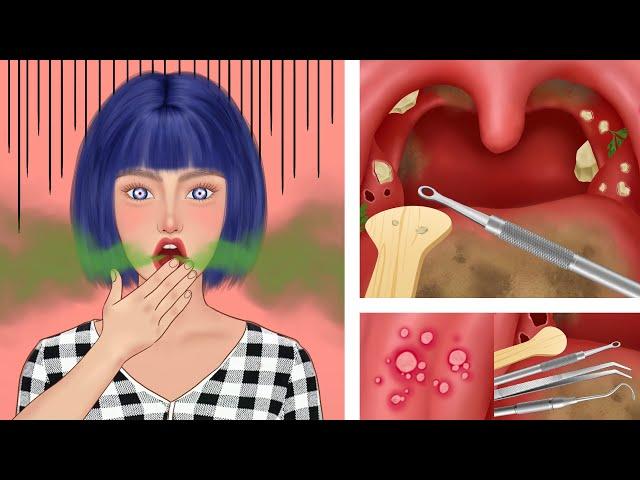 ASMR animation｜Pretty girl cleaning tonsil stones｜clean the tongue