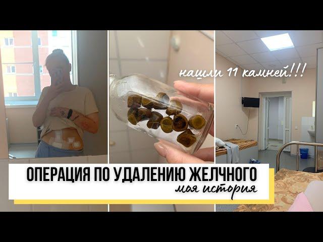 УДАЛЕНИЕ ЖЕЛЧНОГО ПУЗЫРЯ / МОЙ ОПЫТ ОПЕРАЦИИ | ЖКБ, лапароскопия