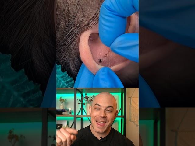 Derm reacts to a very hairy ear-piercing removal! #dermreacts #doctorreacts #earpiercing