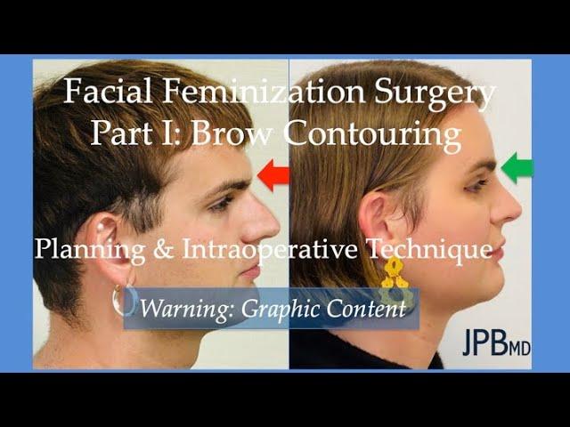 Facial Feminization Surgery Part I: Brow Contouring Planning and Intraoperative Technique