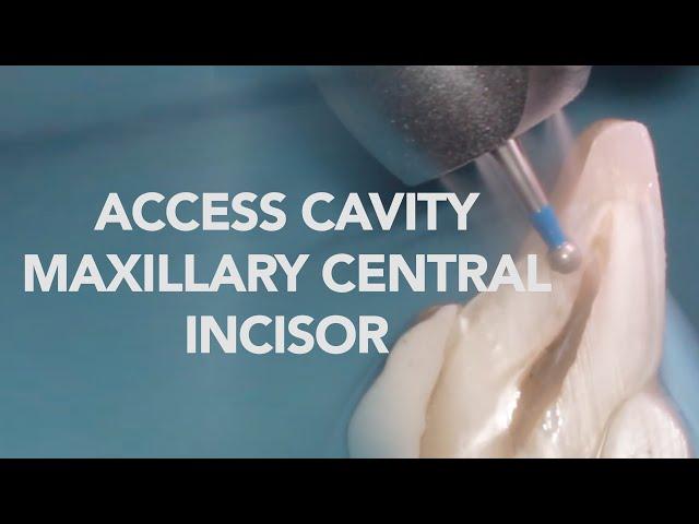 Endodontic Access Cavity of Maxillary Central Incisor - Occlusal & Sectional View