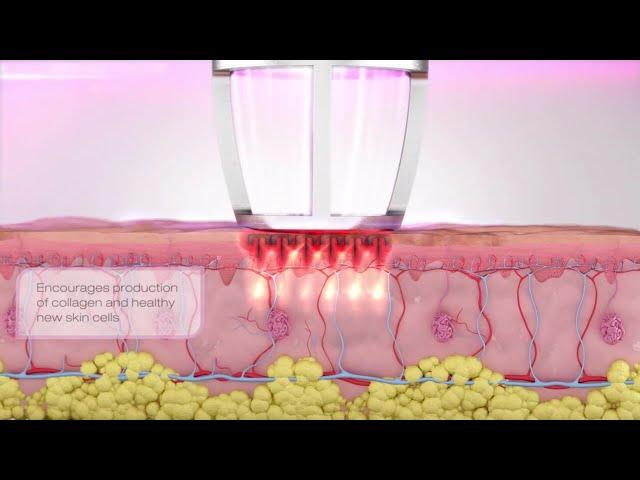 CO2 RE - фракционный лазер для шлифовки от Candela