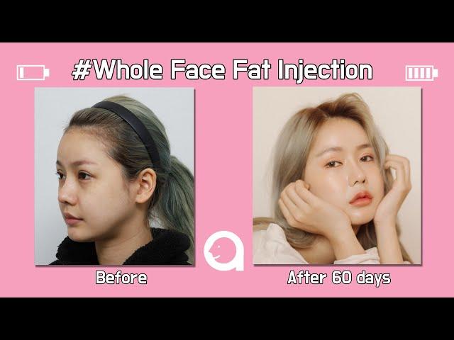 Full Face Fat Transfer at ATOP Plastic Surgery Korea!