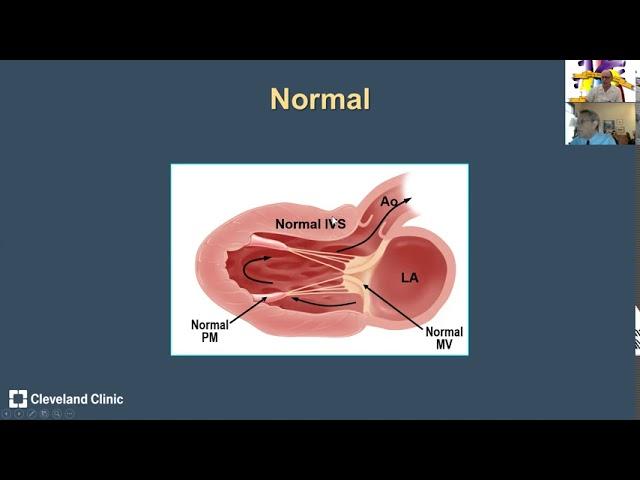 Hypertrophic Cardiomyopathy: Anatomic Variants and Echocardiographic Pearls from Dr Harry Lever