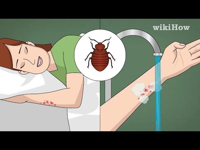 How to Treat Bed Bug Bites