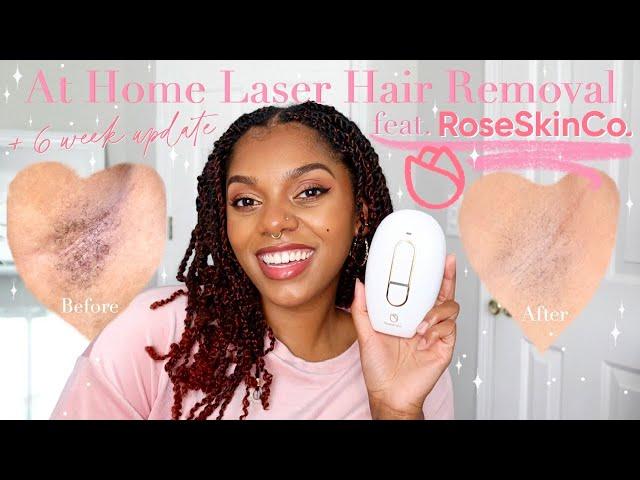 Brown Skin At Home Laser Hair Removal + 6 Week Update ft. Lumi RoseSkinCo. || Glow Like a Goddess!