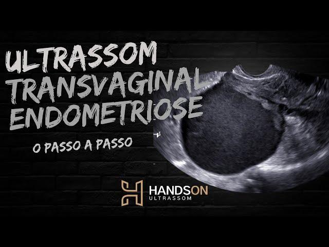 Ultrassonografia Transvaginal com Preparo Intestinal para endometriose / HandsOn Ultrassom