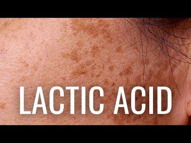 WHY Lactic Acid is Best For Hyperpigmentation