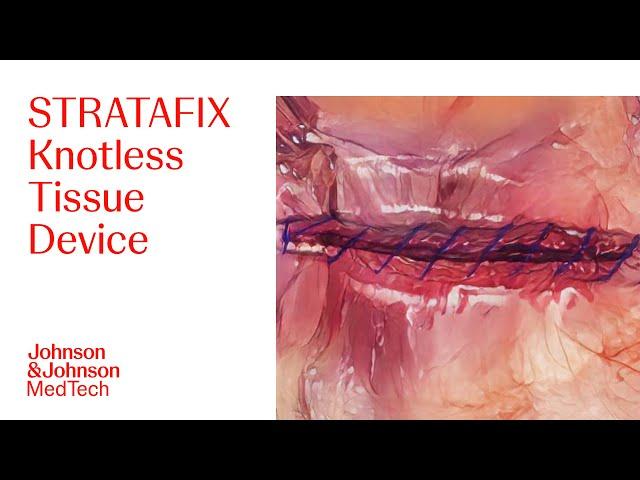 STRATAFIX Spiral PDS Plus Laparoscopic Animation | Ethicon