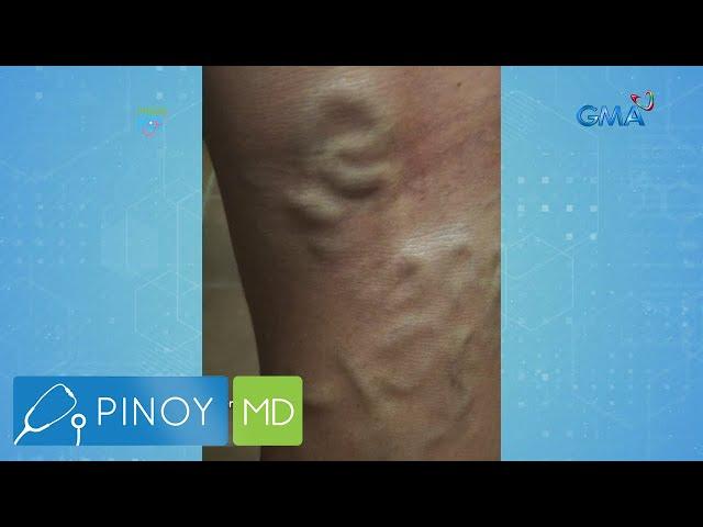 Pinoy MD: Varicose veins, paano malulunasan?