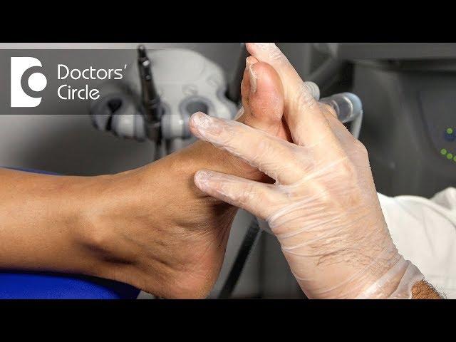 How to manage burning sensation of feet due to Diabetes? - Dr. Mahesh DM