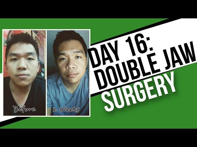 Day 16: Post Double Jaw Surgery