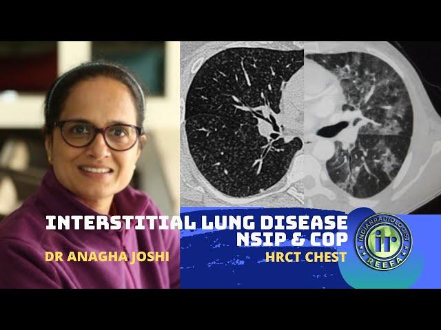 HRCT in ILD | NSIP & COP | Dr Anagha Joshi